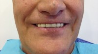 Лечение протезирование зубов в хуньчуне отзывы