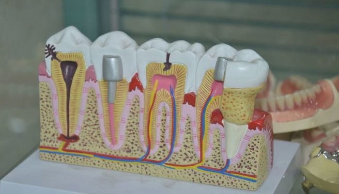 Модель имплантации зубов